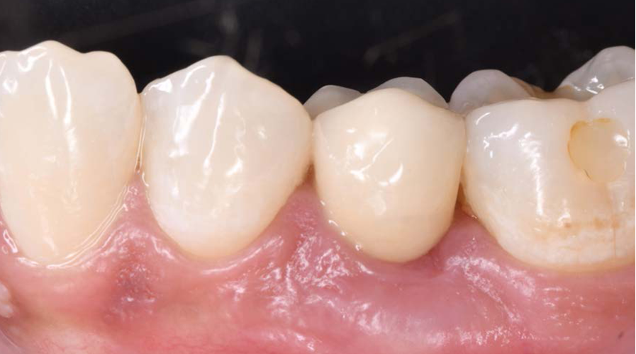 Bone Milling: Perfect Harmony of Function and Feel